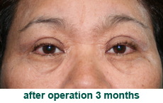 plastic-surgery-blepharoplasty